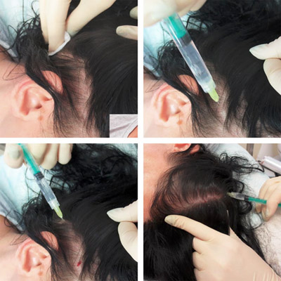 Введение инъекций в кожу головы