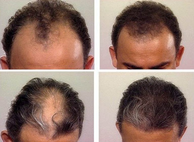 Никотиновая кислота для волос до и после фото мужчины