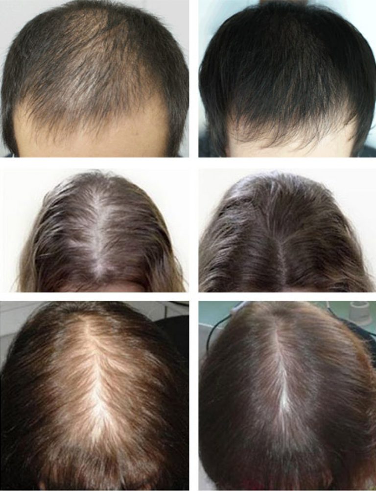 Как быстро отрастить волосы мезотерапия