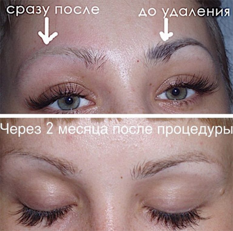 Лазерное удаление перманентного макияжа бровей фото до и после