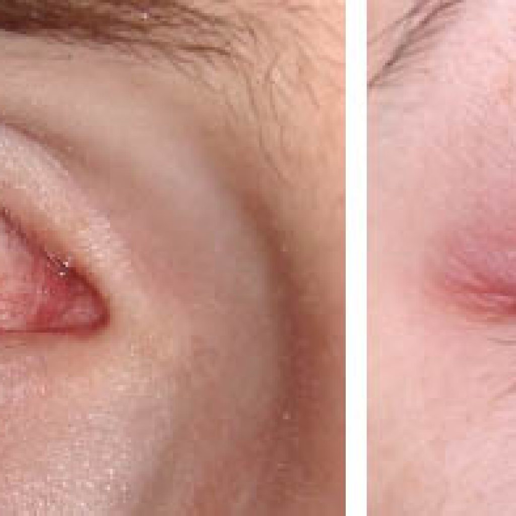 Покраснение глаз после процедуры наращивания