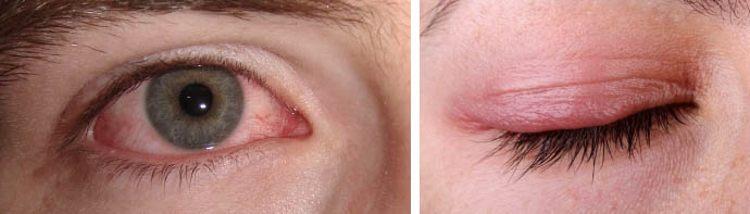 Покраснение глаз после процедуры наращивания