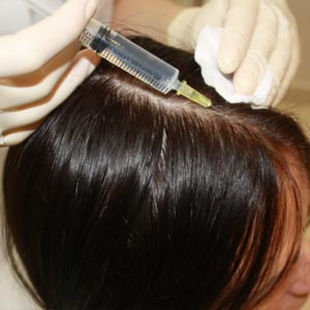 Мезотерапия волосистой головы