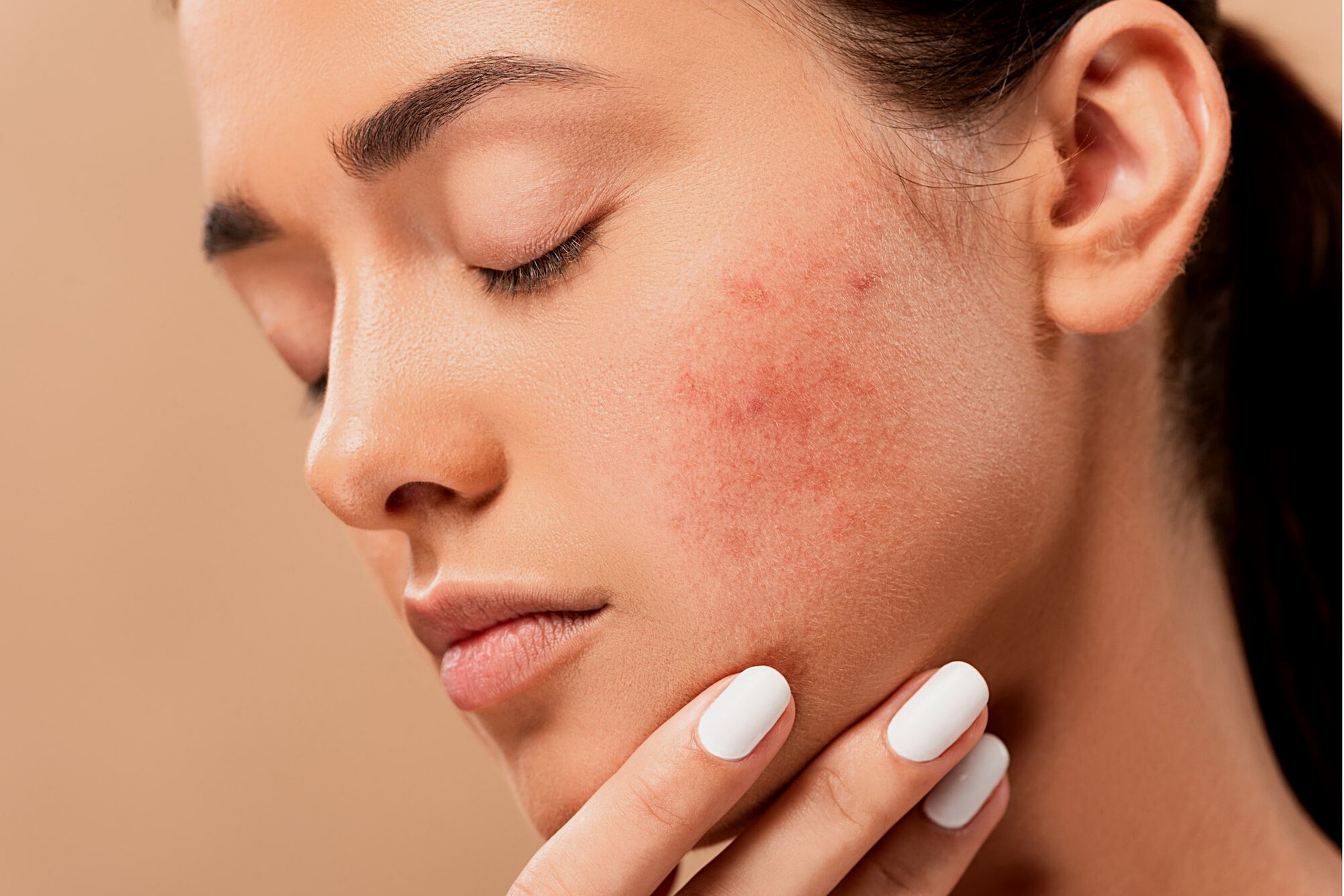 Причины и лечение акне: Советы по уходу за проблемной кожей